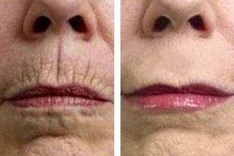 Ácido Hialurónico Facial