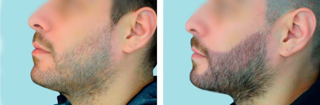 Confía en la Clínica Continental para obtener los mejores resultados en el implante de barba antes y después. Mira la transformación de uno de nuestros pacientes satisfechos, con un antes y después de la cirugía de implante de barba.