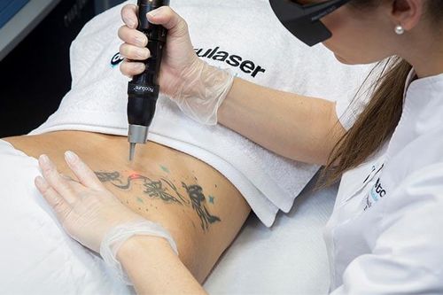 Mira los impresionantes resultados de la eliminación de tatuajes antes y después en Clínica Continental. Nuestros profesionales cuentan con la experiencia y los últimos avances en tecnología para ayudar a los pacientes a eliminar sus tatuajes de forma segura y eficaz.