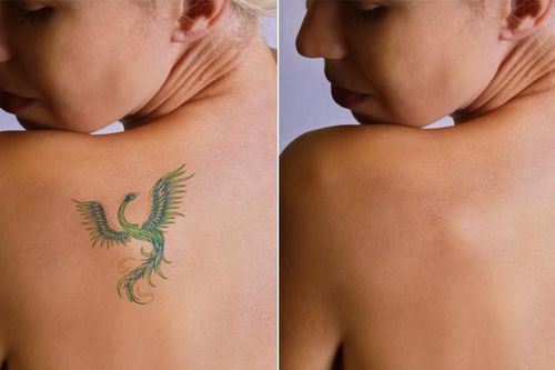 Conozca los sorprendentes resultados de la eliminación de tatuajes antes y después en Clínica Continental. Nuestros profesionales cuentan con la experiencia y la tecnología más avanzada para ayudar a los pacientes a eliminar sus tatuajes de forma segura y eficaz.