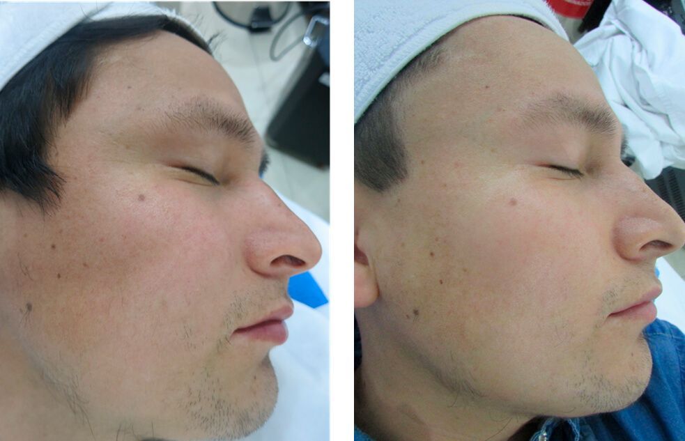 resultados de casos antes y después con Laser Spectra.