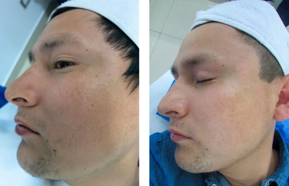 resultados antes y después para eliminar las manchas.
