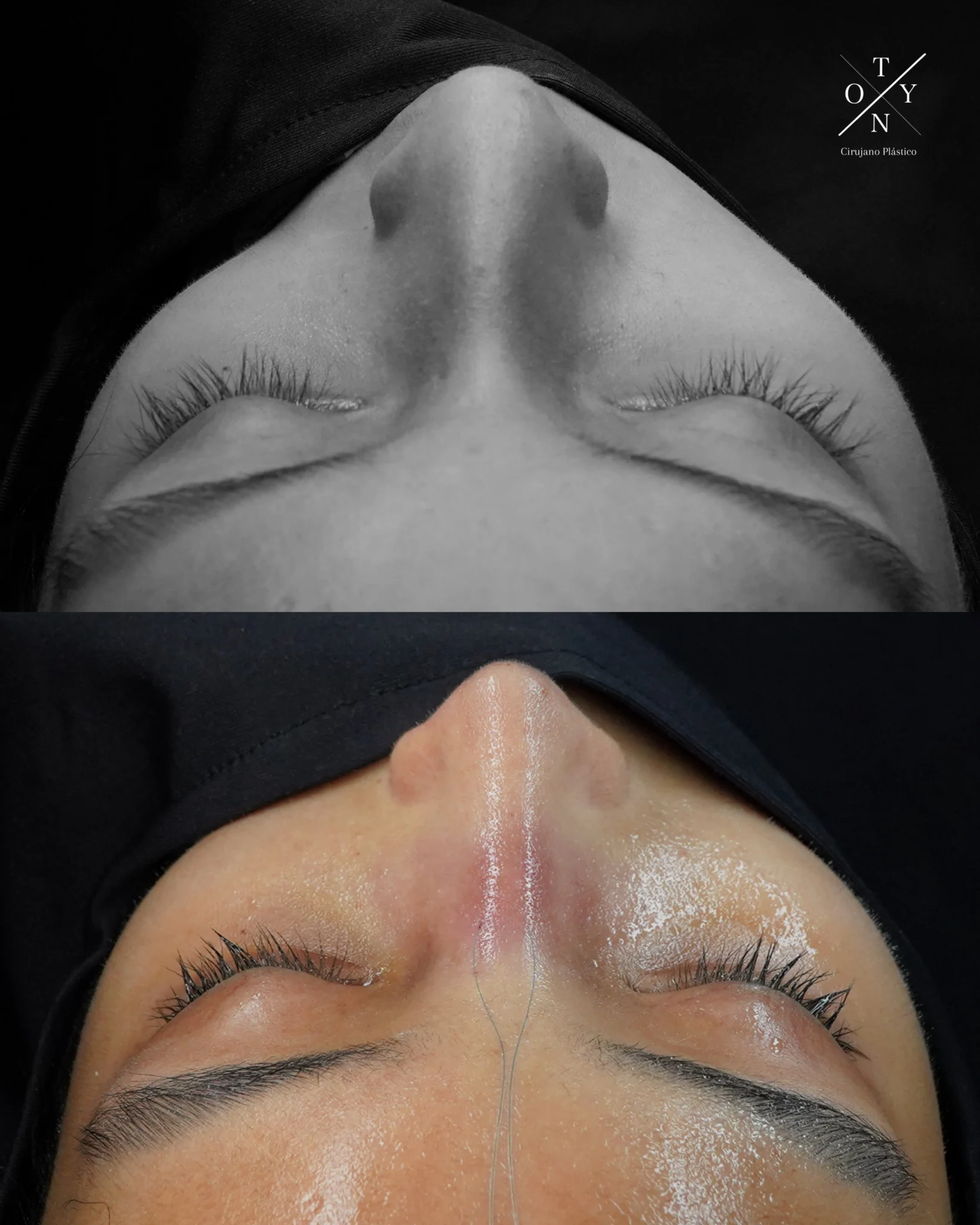 La rinoplastia puede ayudar a mejorar la forma y la apariencia de tu nariz. Mira los cambios antes y después con esta fotografía