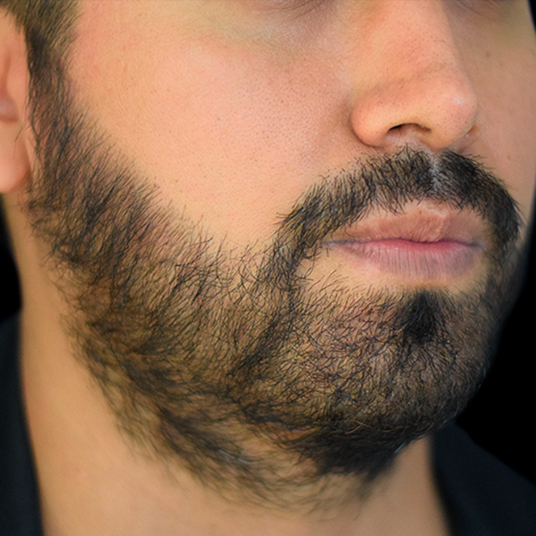 La Clínica Continental ofrece la mejor experiencia en el implante de barba antes y después. Mira los resultados de uno de nuestros pacientes satisfechos, con un antes y después de la cirugía de implante de barba.
