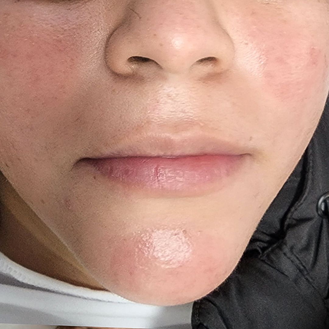 El tratamiento láser Fotona ha demostrado ser una forma efectiva de tratar el acné activo. Estas fotografías muestran los resultados antes y después de la terapia. El tratamiento es seguro y cómodo, y los resultados duran por mucho tiempo