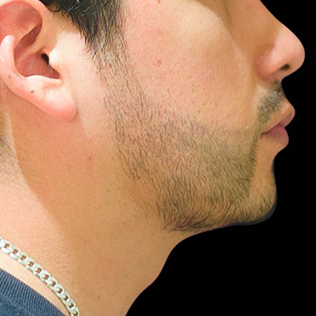 Los expertos de la Clínica Continental ofrecen excelentes resultados con el implante de barba antes y después. Mira los resultados de uno de nuestros pacientes satisfechos, con un antes y después de la cirugía de implante de barba.