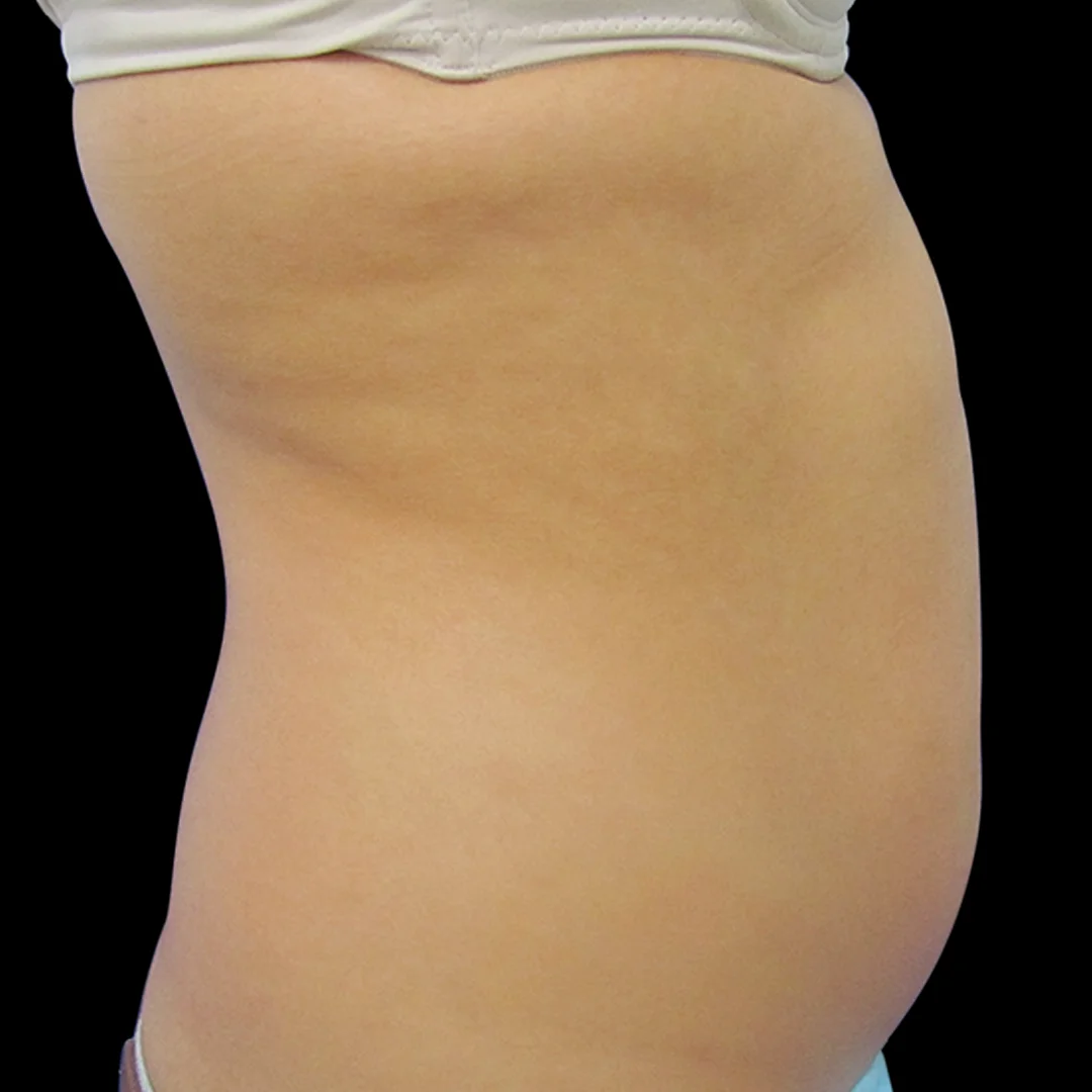 ¡Consigue una piel más suave y juvenil con el tratamiento con Exilis Elite en Clínica Continental! Descubre los resultados antes y después de la reducción de flacidez con Exilis Elite en Clínica Continental.